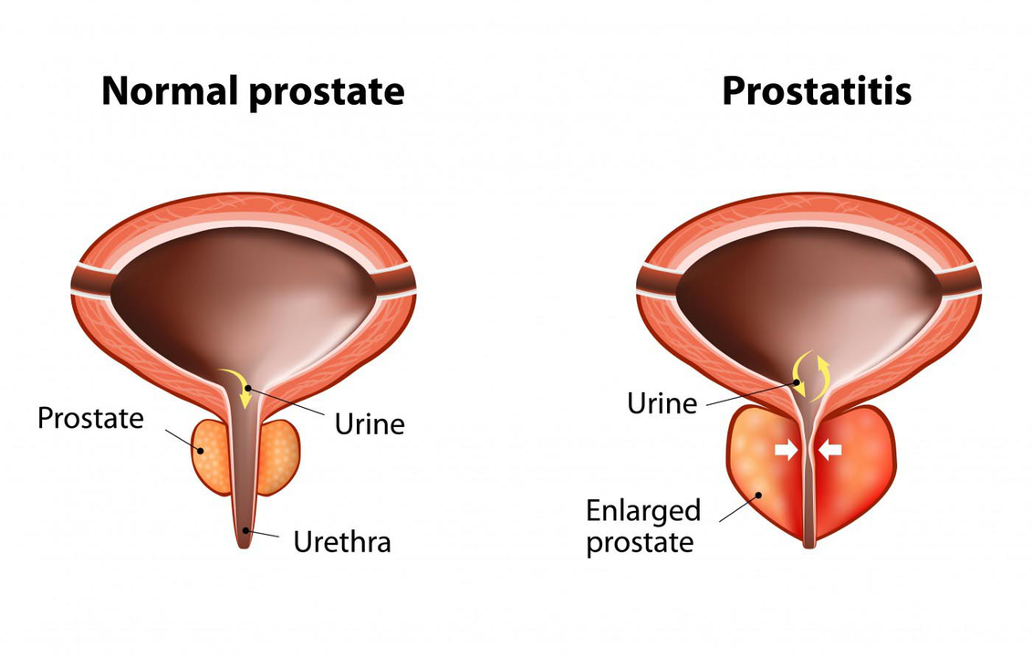 Normal prostate of a healthy man and inflammation of the prostate gland in prostatitis